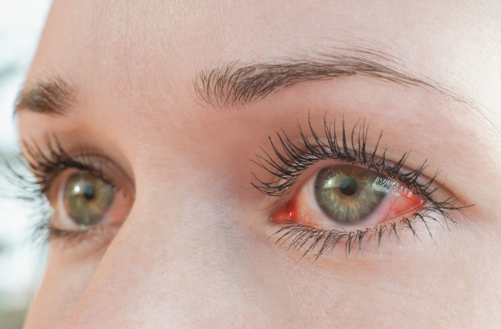 A close-up of a woman's red eye caused by allergies.