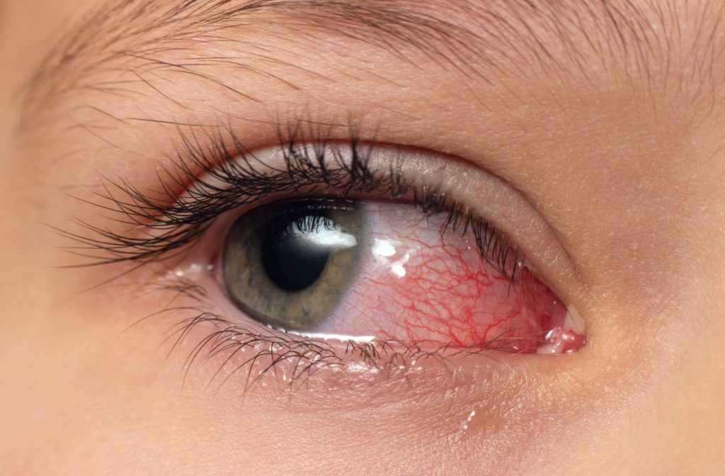 A close-up image of an infected eye, preventing the individual from wearing contact lenses.