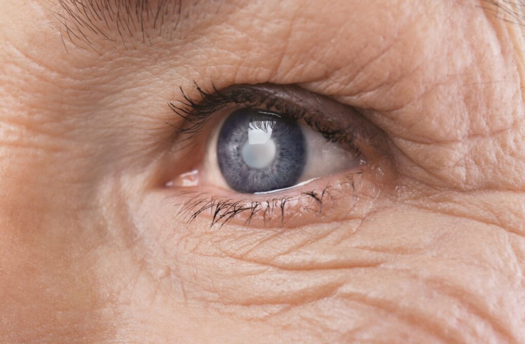 Close-up of a person's eye with a cloudy cataract visible in the center.